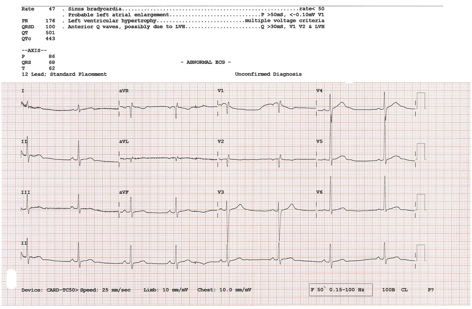 Arkivbild: EKG-undersökning